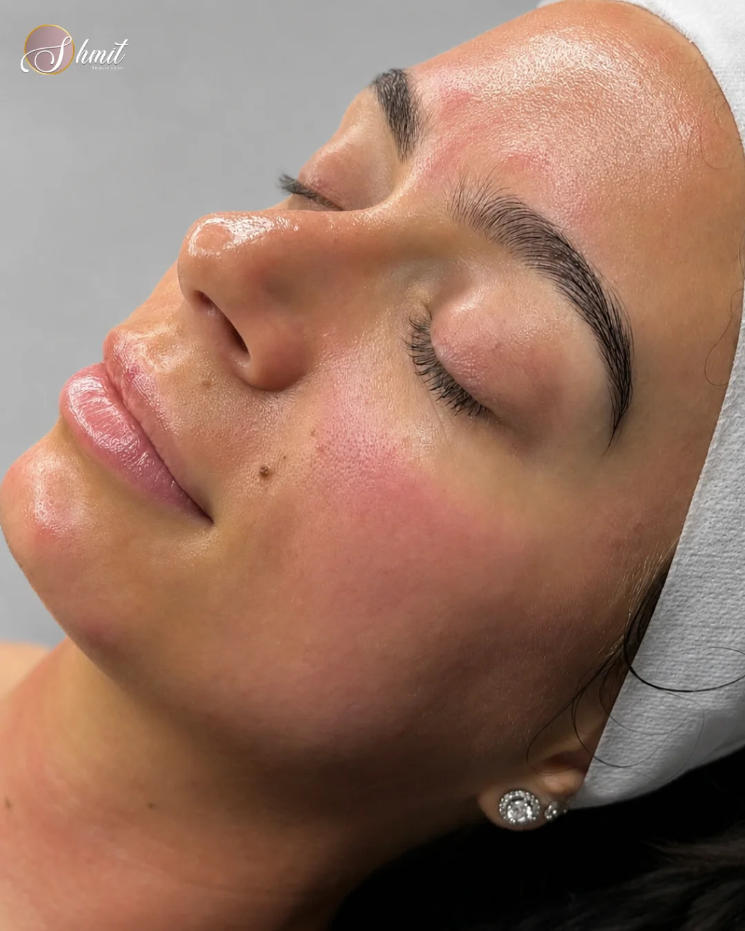 Primer plano de rostro tras tratamiento facial profesional en Madrid