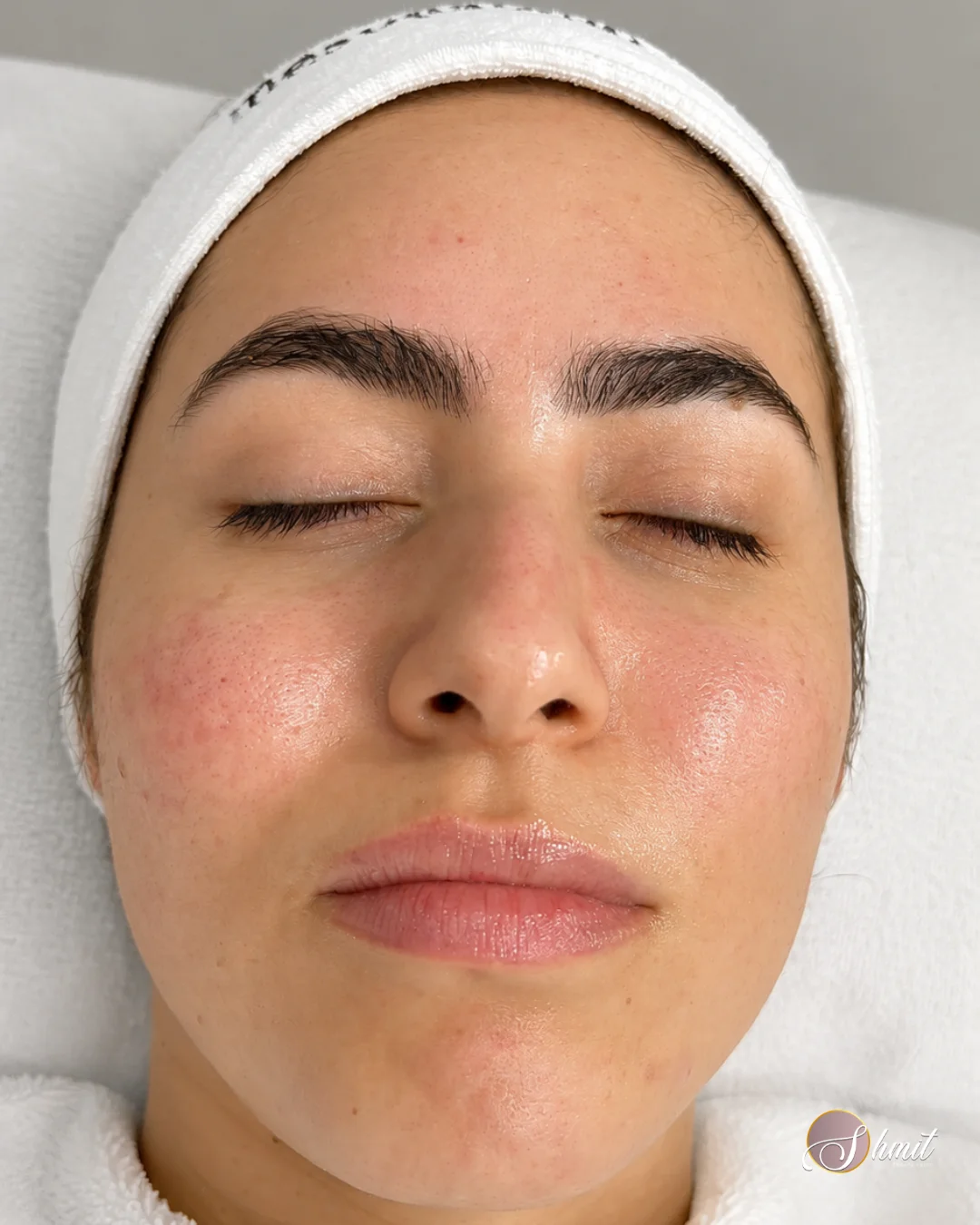 Resultado de cuidado facial profesional con piel de aspecto descansado en Madrid